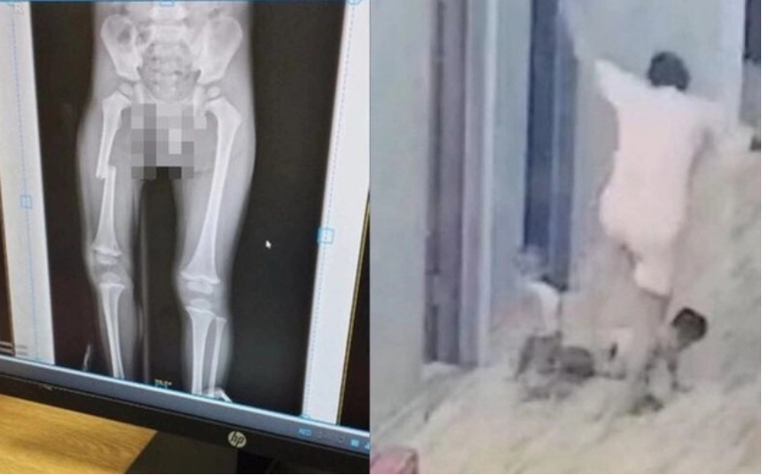 Xác minh clip cháu bé bị mẹ đạp gãy xương đùi ở Bắc Giang