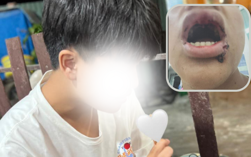 Nam sinh 14 tuổi bị đánh gãy răng, nhấn xuống nước khi đi tắm biển tại Đà Nẵng