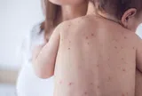 Trẻ em có thể mắc bệnh đậu mùa khỉ không, cần làm gì nếu có triệu chứng nghi ngờ?