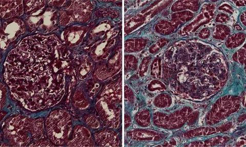 Nhiễm virus corona có thể gây tổn thương thận