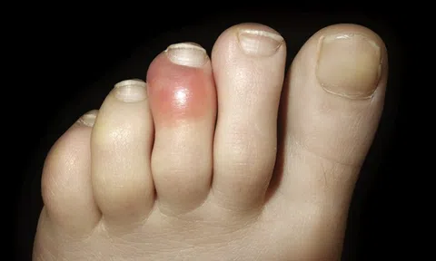 Hiện tượng “ngón chân COVID” có thật hay không?