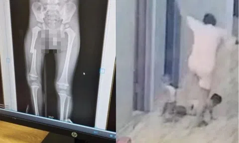 Xác minh clip cháu bé bị mẹ đạp gãy xương đùi ở Bắc Giang