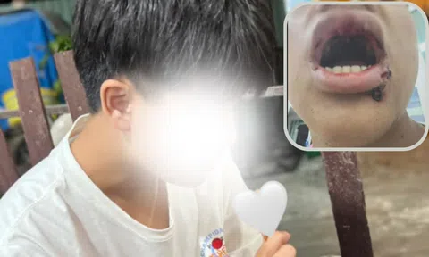 Nam sinh 14 tuổi bị đánh gãy răng, nhấn xuống nước khi đi tắm biển tại Đà Nẵng