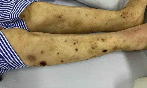 Sai lầm khi dùng ong châm để điều trị giảm đau