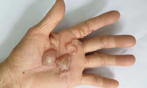 Nhiễm ký sinh trùng từ động vật nuôi trong nhà