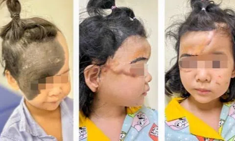 Hành trình tìm lại khuôn mặt xinh đẹp cho bé gái có u hắc tố khổng lồ