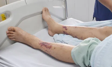 Đừng để món khoái khẩu khiến bạn nguy kịch tính mạng