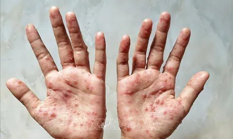 Những triệu chứng điển hình của bệnh đậu mùa khỉ
