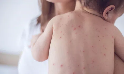 Trẻ em có thể mắc bệnh đậu mùa khỉ không, cần làm gì nếu có triệu chứng nghi ngờ?